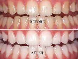 teeth-whitening